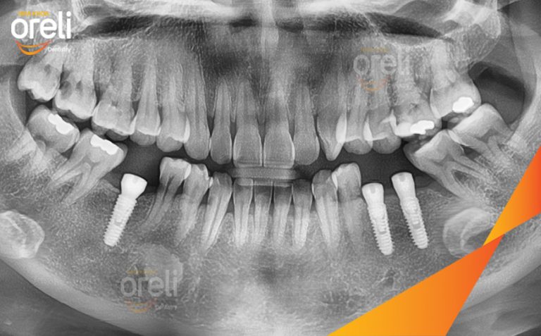 Phục Hồi 3 Răng Hàm Dưới Đã Mất Bằng Implant l Nha Khoa Oreli