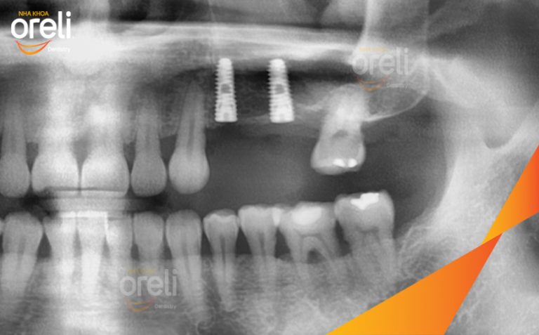Phục Hồi Răng Mất Hàm Trên Bằng Implant Tại Nha Khoa Oreli