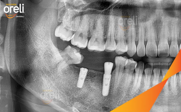 Ca Cấy Ghép Implant Phục Hồi Răng Mất Hàm Dưới Tại Nha Khoa Oreli