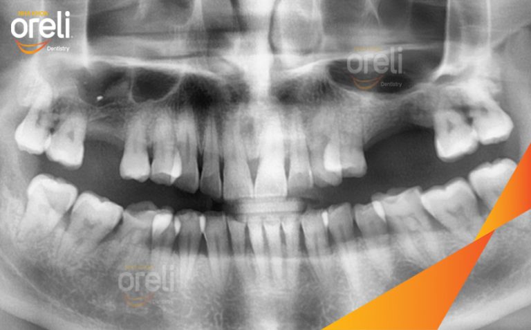 Ca Cấy Ghép Implant Phục Hồi Răng Tại Nha Khoa Oreli