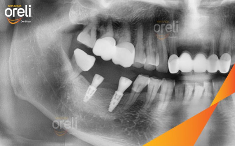 Ca Cấy Implant Phục Hồi Răng Mất Hàm Dưới Tại Nha Khoa Oreli