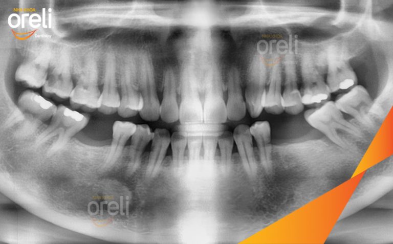 Phục Hồi 3 Răng Hàm Dưới Đã Mất Bằng Implant l Nha Khoa Oreli