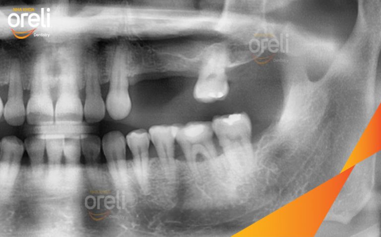 Phục Hồi Răng Mất Hàm Trên Bằng Implant Tại Nha Khoa Oreli