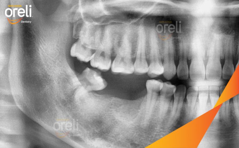 Ca Cấy Ghép Implant Phục Hồi Răng Mất Hàm Dưới Tại Nha Khoa Oreli