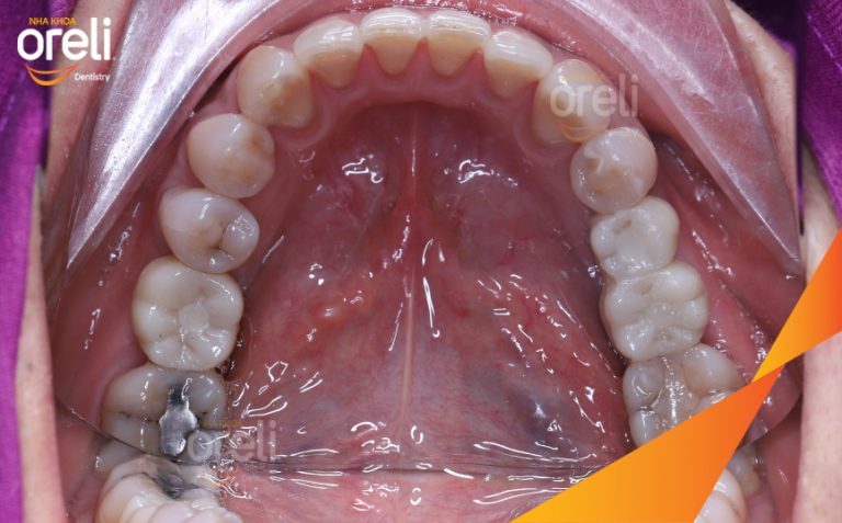 Phục Hồi 3 Răng Hàm Dưới Đã Mất Bằng Implant l Nha Khoa Oreli