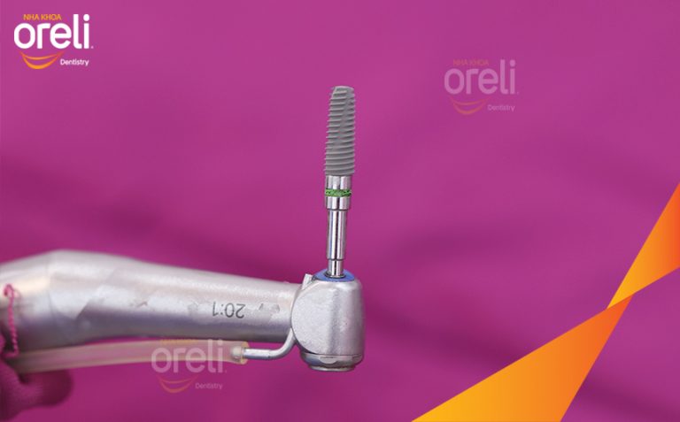 Ca Cấy Ghép Implant Phục Hồi Răng Mất Hàm Dưới Tại Nha Khoa Oreli