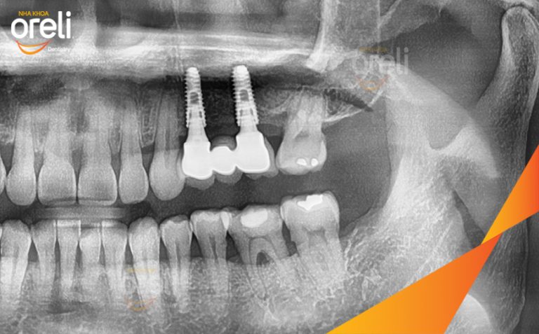 Phục Hồi Răng Mất Hàm Trên Bằng Implant Tại Nha Khoa Oreli