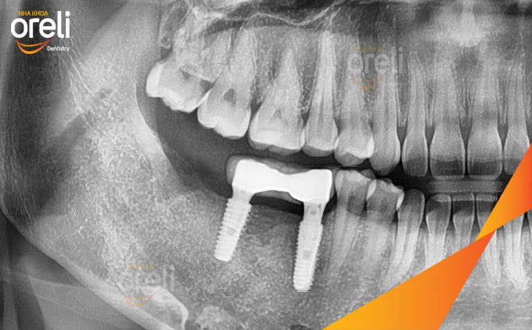 Ca Cấy Ghép Implant Phục Hồi Răng Mất Hàm Dưới Tại Nha Khoa Oreli