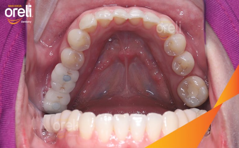 Ca Cấy Ghép Implant Phục Hồi Răng Mất Hàm Dưới Tại Nha Khoa Oreli