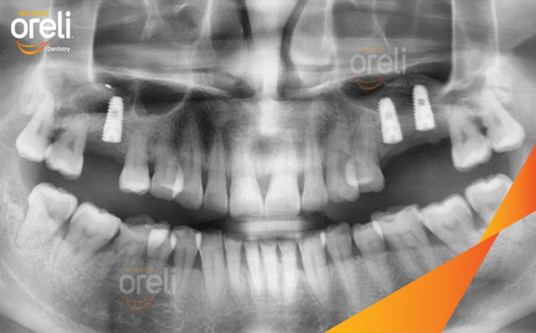 Ca Cấy Ghép Implant Phục Hồi Răng Tại Nha Khoa Oreli