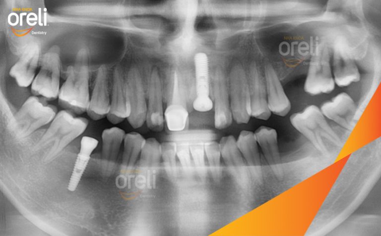 Phục Hồi 2 Răng Mất Bằng Implant Ở Hàm Trên Và Hàm Dưới l Nha Khoa Oreli