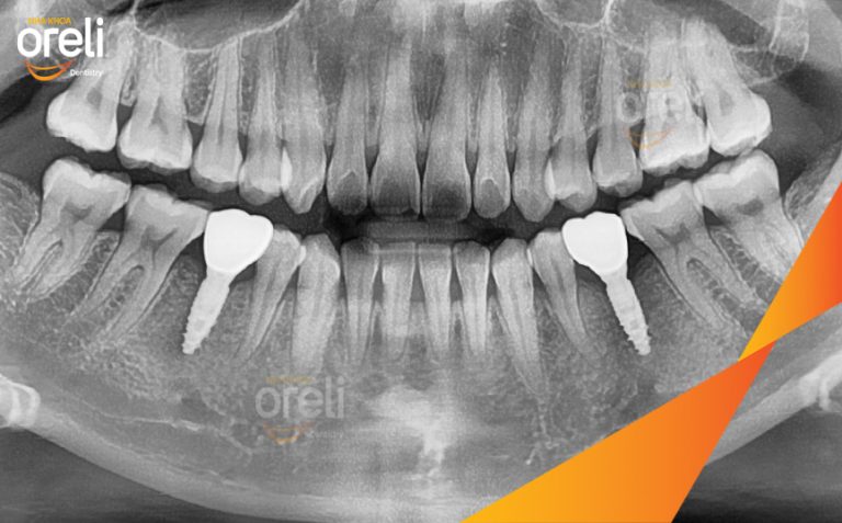 Ca Cấy Implant Phục Hồi 2 Răng Hàm Dưới Tại Nha Khoa Oreli