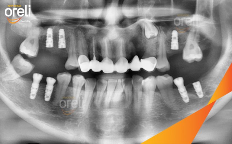 Ca Cấy 7 Trụ Implant Phục Hồi Răng Mất Tại Nha Khoa Oreli