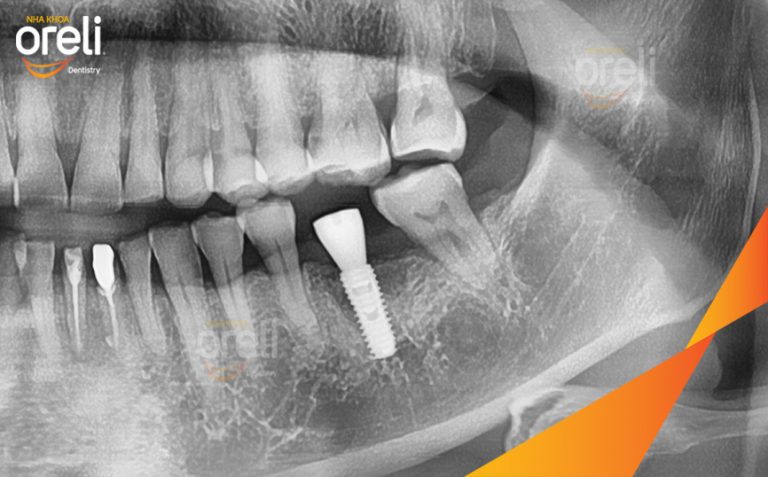 Ca cấy Implant Phục Hồi Răng số 36 Đã Mất Tại Oreli