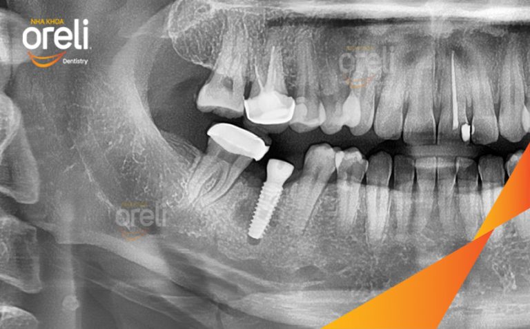 Ca Cấy Ghép Implant Hàm Dưới Tại Oreli