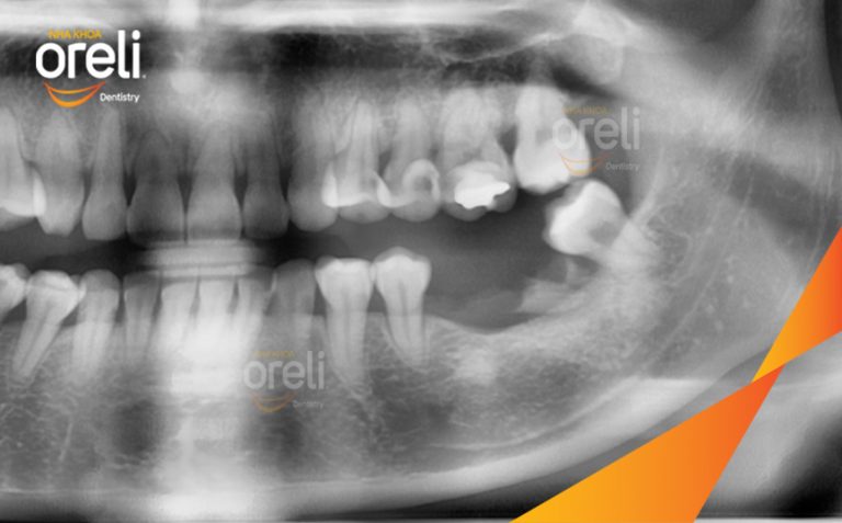 Cấy Ghép Implant Hàm Dưới – Phục Hồi Răng Mất Tại Oreli