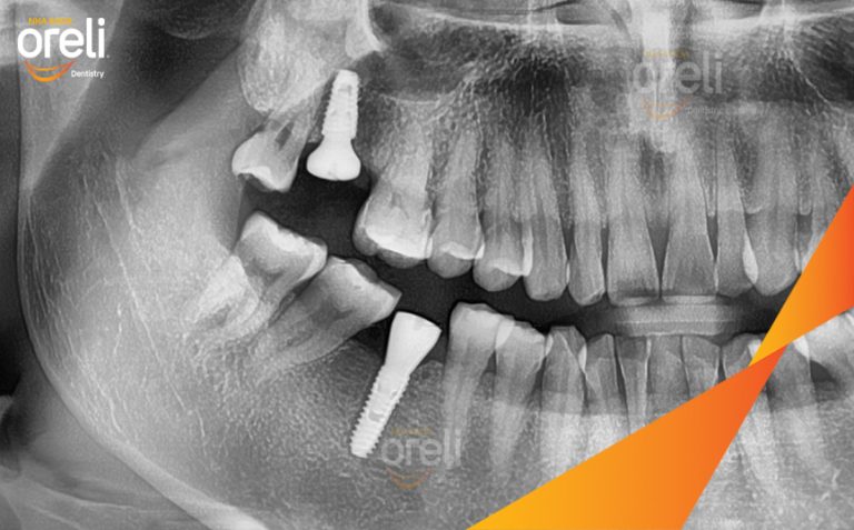 Phục Hồi Răng Mất Hàm Trên Và Dưới Bằng Implant l Tại Nha Khoa Oreli