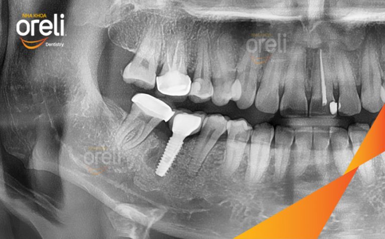 Ca Cấy Ghép Implant Hàm Dưới Tại Oreli