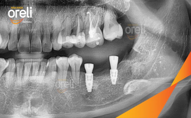 Cấy Ghép Implant Hàm Dưới – Phục Hồi Răng Mất Tại Oreli