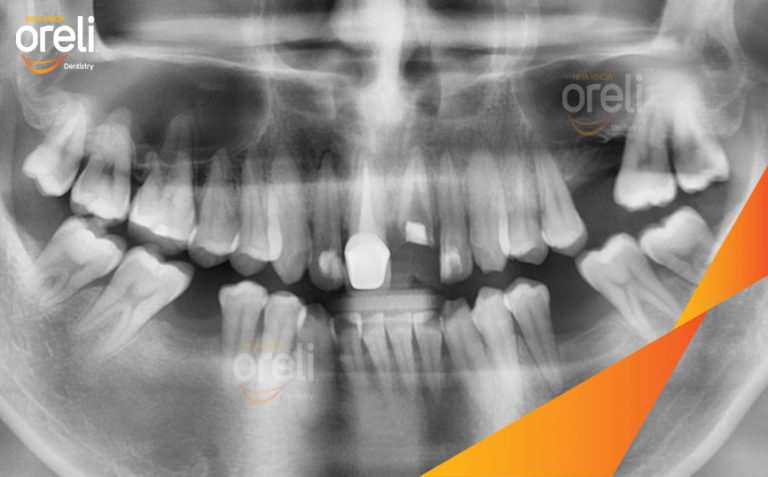 Phục Hồi 2 Răng Mất Bằng Implant Ở Hàm Trên Và Hàm Dưới l Nha Khoa Oreli