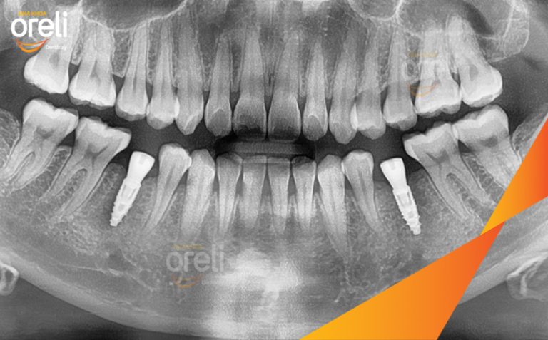 Ca Cấy Implant Phục Hồi 2 Răng Hàm Dưới Tại Nha Khoa Oreli