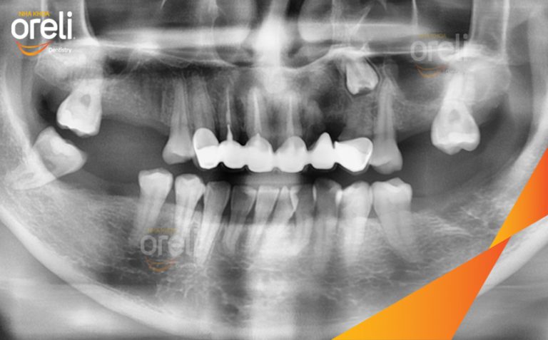 Ca Cấy 7 Trụ Implant Phục Hồi Răng Mất Tại Nha Khoa Oreli