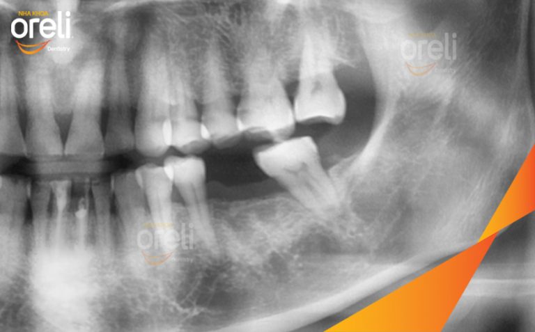 Ca cấy Implant Phục Hồi Răng số 36 Đã Mất Tại Oreli