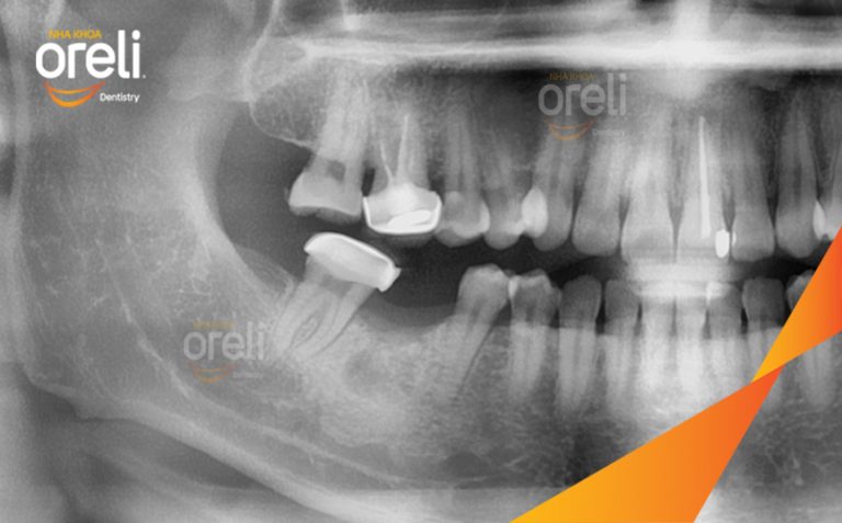 Ca Cấy Ghép Implant Hàm Dưới Tại Oreli