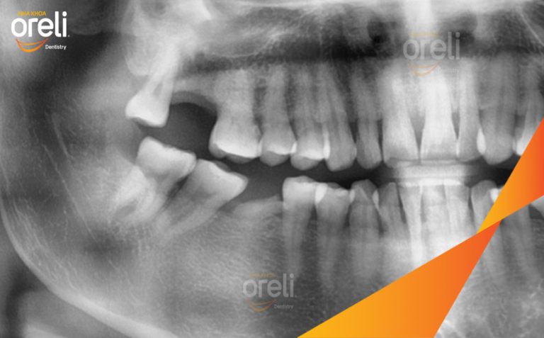 Phục Hồi Răng Mất Hàm Trên Và Dưới Bằng Implant l Tại Nha Khoa Oreli