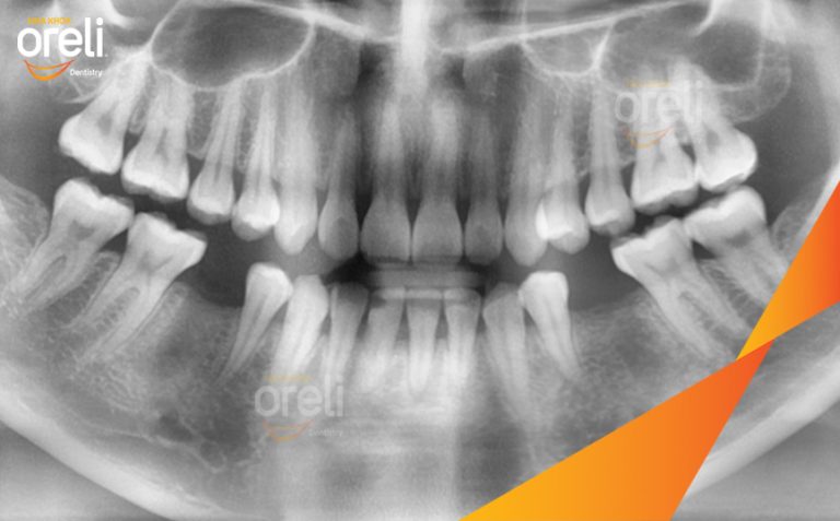 Ca Cấy Implant Phục Hồi 2 Răng Hàm Dưới Tại Nha Khoa Oreli