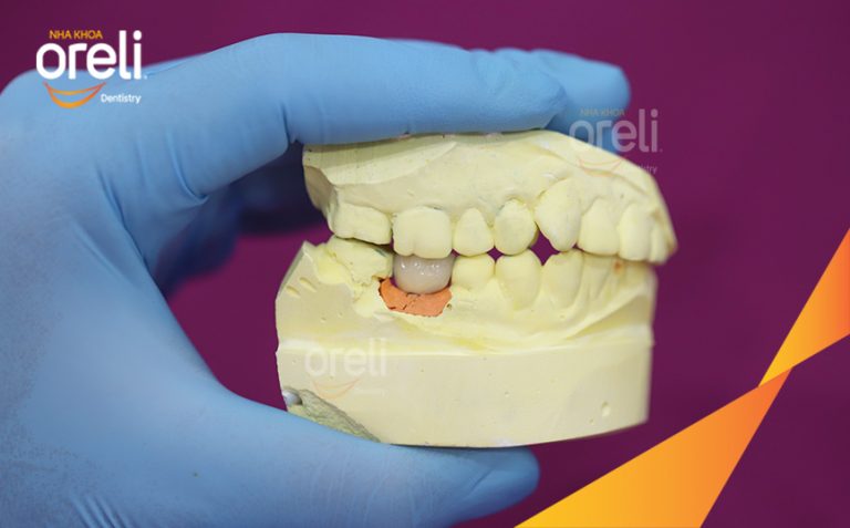 Ca Cấy Ghép Implant Hàm Dưới Tại Oreli