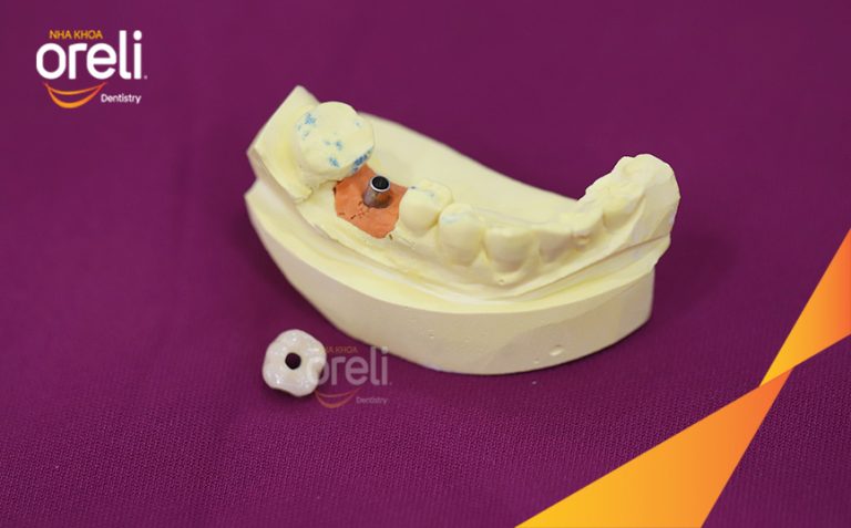 Ca Cấy Ghép Implant Hàm Dưới Tại Oreli