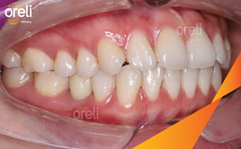 Ca Cấy Implant Phục Hồi 2 Răng Hàm Dưới Tại Nha Khoa Oreli