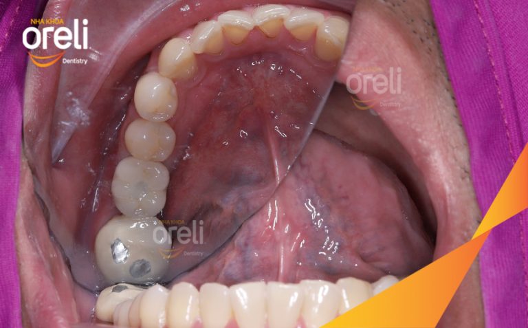 Ca Cấy Ghép Implant Hàm Dưới Tại Oreli