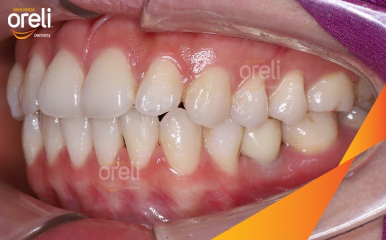 Ca Cấy Implant Phục Hồi 2 Răng Hàm Dưới Tại Nha Khoa Oreli