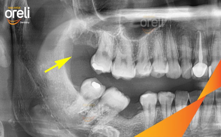Nhổ Răng Khôn Hàm Trên – Case thực tế tại Nha khoa Oreli