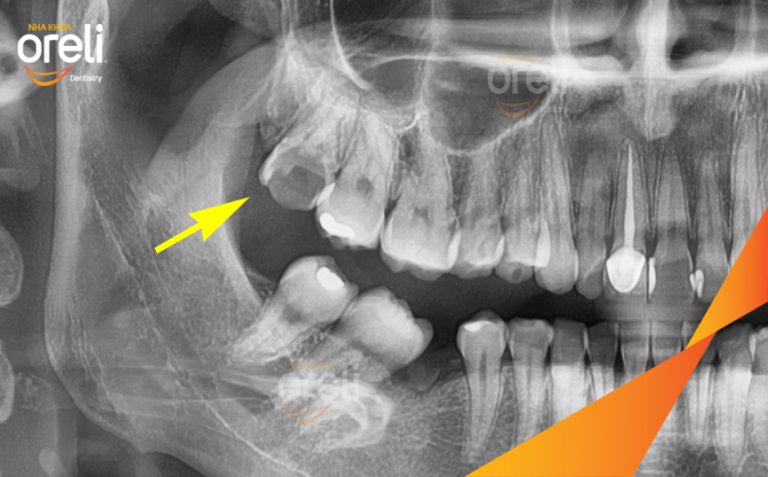 Nhổ Răng Khôn Hàm Trên – Case thực tế tại Nha khoa Oreli