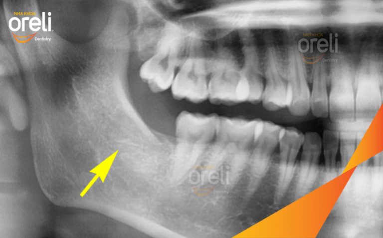 Ca Nhổ Răng Khôn Mọc Lệch | Nha khoa Oreli