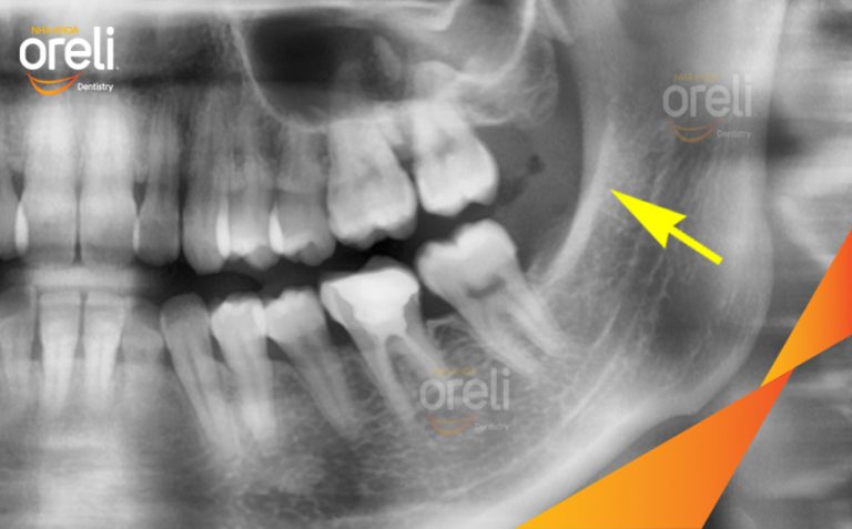 Ca Nhổ Răng Khôn Hàm Trên – Kết quả sau điều trị tại Oreli