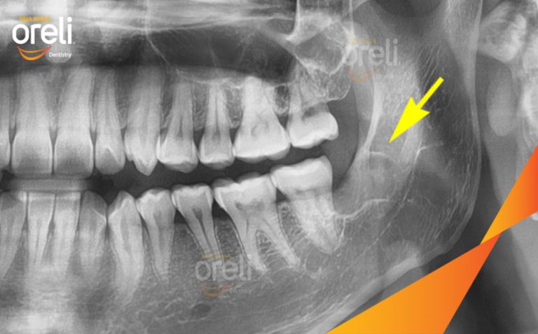 Xử Lý Răng Khôn Mọc Lệch Hàm Dưới Tại Nha khoa Oreli