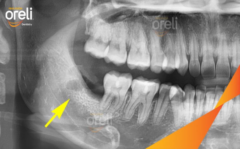 Nhổ Răng Khôn Mọc Ngang – Ca thực tế tại Oreli Buôn Ma Thuột