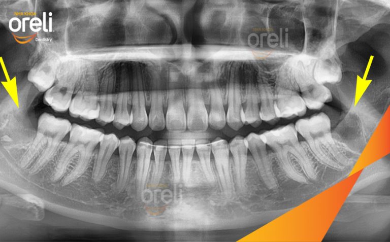 Ca Nhổ Răng Khôn Mọc Lệch Tại Buôn Ma Thuột | Nha khoa Oreli