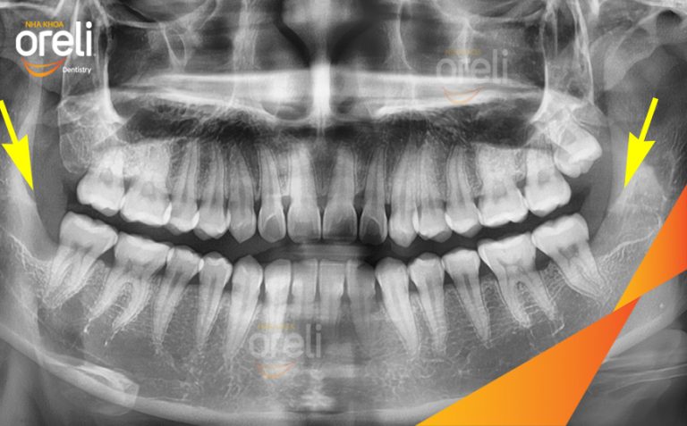 Ca Nhổ 2 Chiếc Răng Khôn Mọc Lệch Tại Nha khoa Oreli