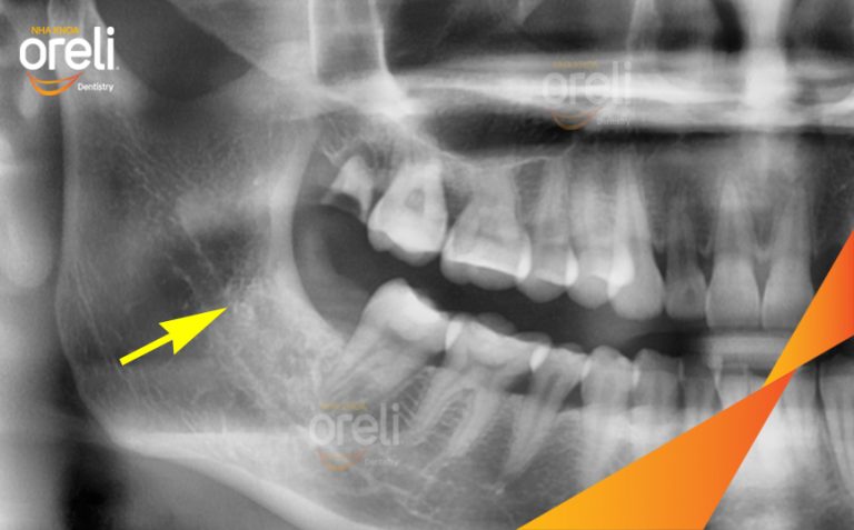 Ca Nhổ Răng Khôn – Hình Ảnh Trước Và Sau Khi Nhổ răng Khôn Tại Oreli