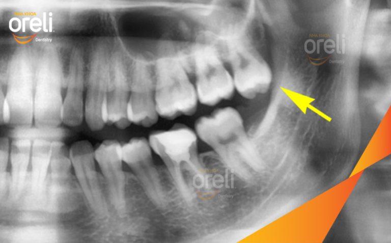 Ca Nhổ Răng Khôn Hàm Trên – Kết quả sau điều trị tại Oreli