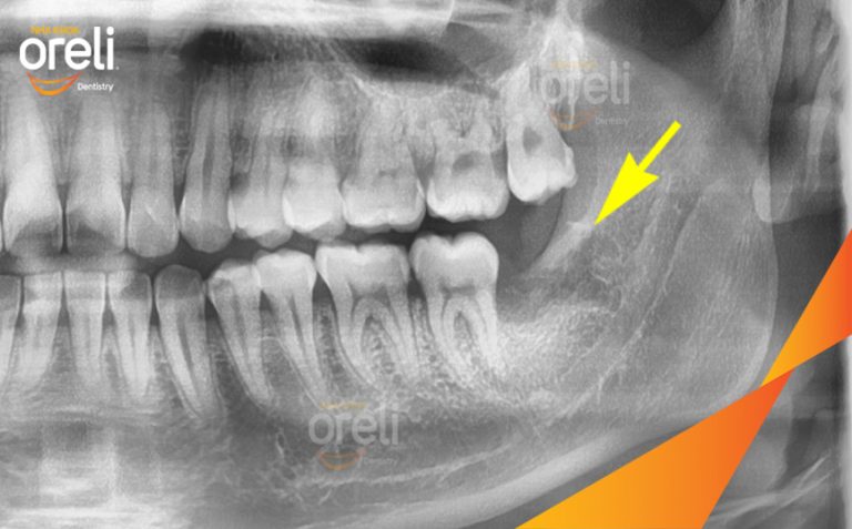 Ca Nhổ Răng Khôn Hàm Dưới Mọc Lệch – Ca điều trị tại Oreli