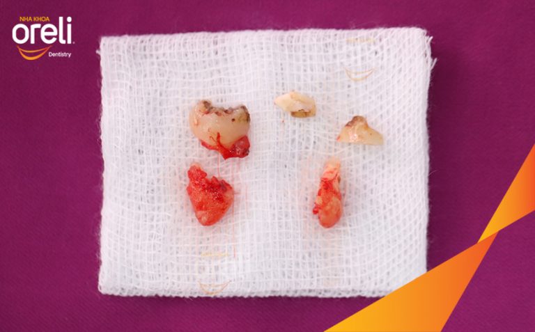 Nhổ Răng Khôn Mọc Ngang – Ca thực tế tại Oreli Buôn Ma Thuột