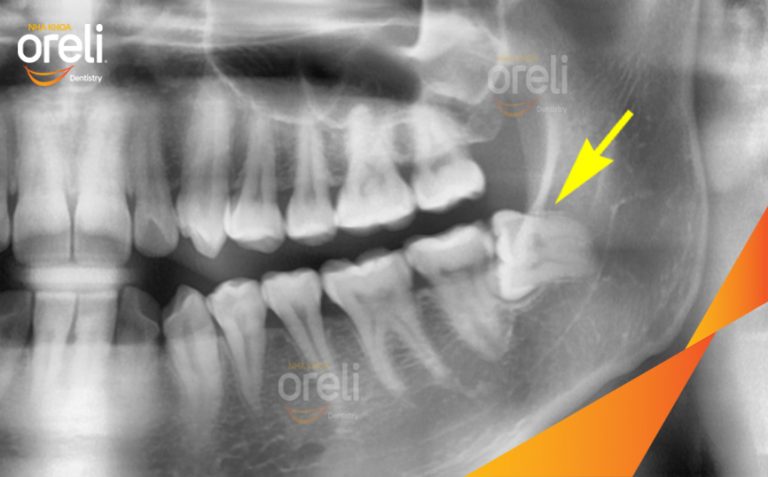 Xử Lý Răng Khôn Mọc Lệch Hàm Dưới Tại Nha khoa Oreli