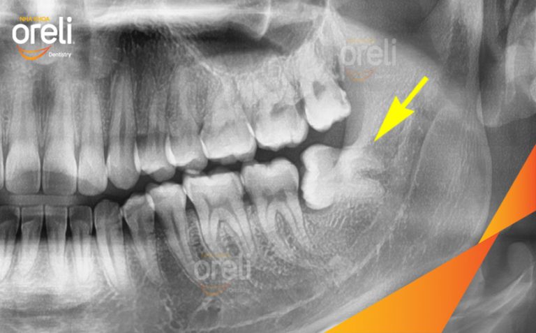 Ca Nhổ Răng Khôn Hàm Dưới Mọc Lệch – Ca điều trị tại Oreli