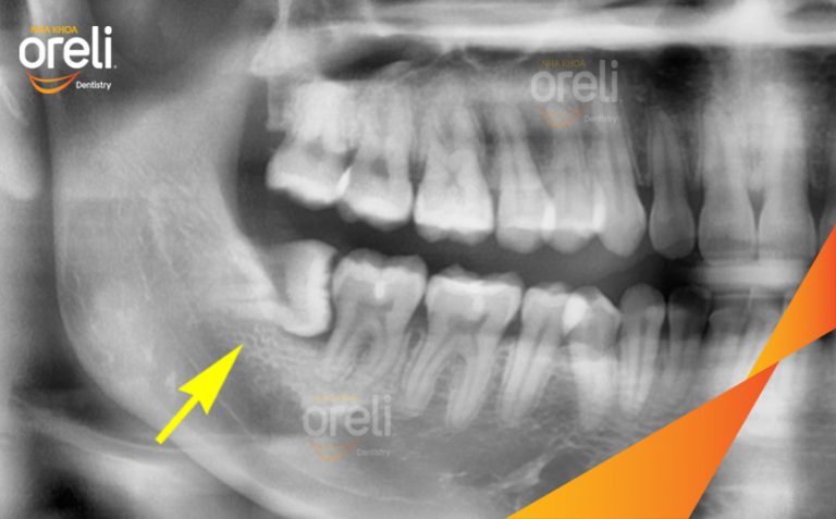 Nhổ Răng Khôn Mọc Ngang – Ca thực tế tại Oreli Buôn Ma Thuột